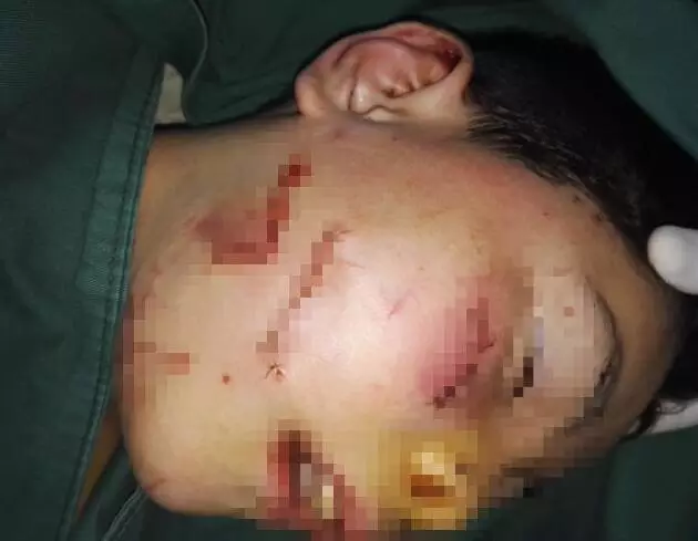 0岁男孩惨遭恶邻毒手，面部砍伤9处舌头被割断。"