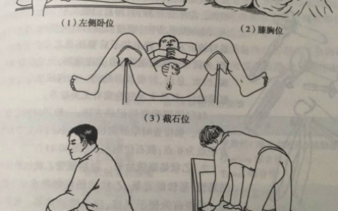 肛门视检：直肠肛管检查体位自选。试过的小伙伴 是否有酸爽的感觉？？