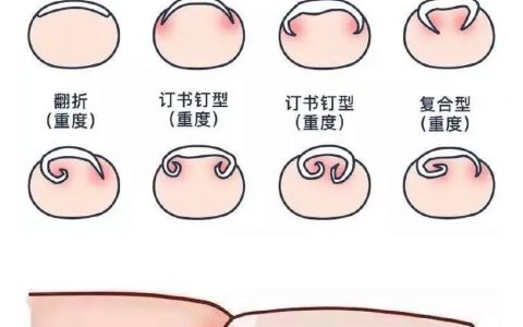 大家的脚指甲一定要剪平啊！！