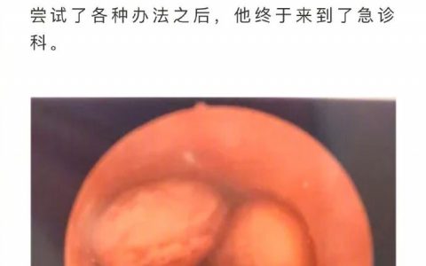 30岁男性将6颗芸豆塞入尿道，自称想当“豌豆射手”获得更多快感