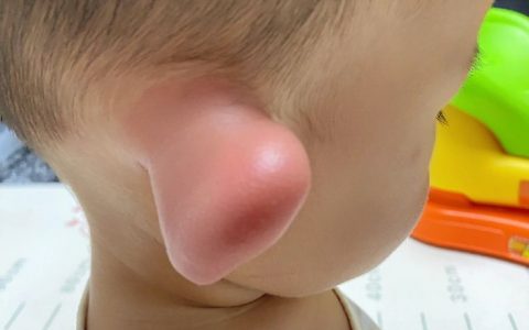 当人类幼崽被蚊子咬了耳朵后，就会变成了猪八戒