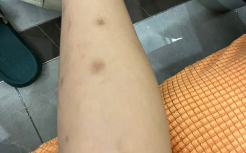 蚊虫叮咬后为什么会留下黑印
